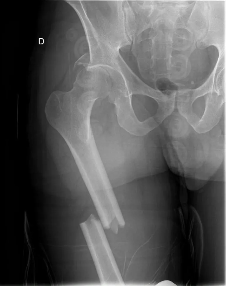 Radiografía que muestra una fractura transversal en la diáfisis femoral.