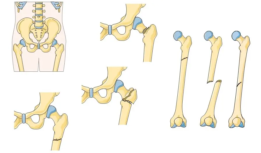 Tipos de fracturas de fémur