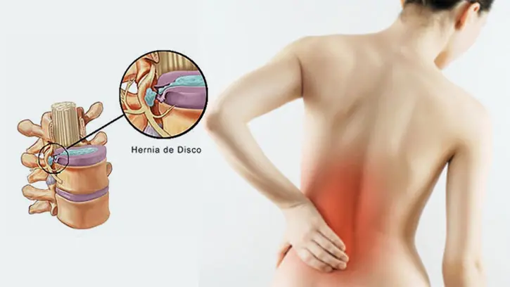hernia discal